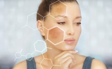 Melasma