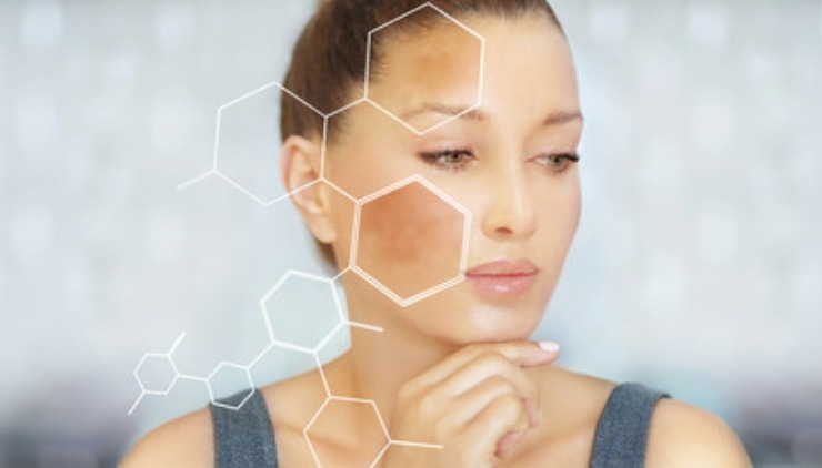 Melasma